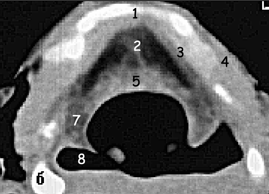 IRM de la thyroïde (cartilage normal)