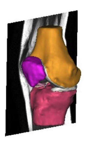 Représentation de la coupe de l'IRM (Source : Automated Segmentation of the Meniscus - Felicia Aldrin)