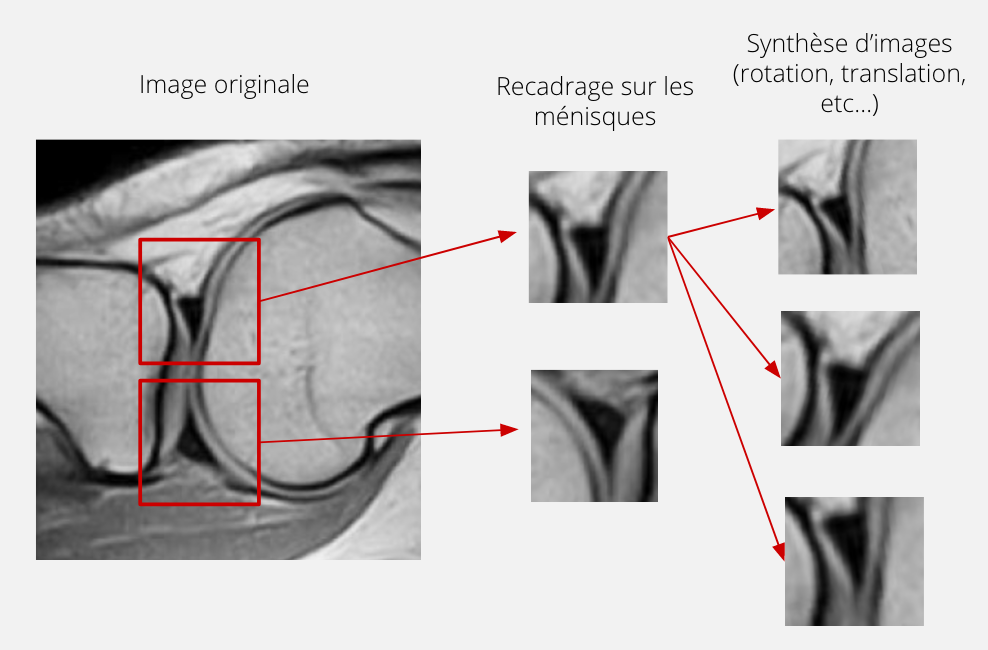 Recentrage sur le ménisque