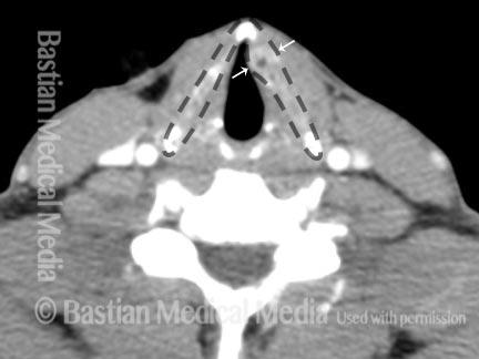 exemples d’IRM de la thyroïde (Source : EURORAD)