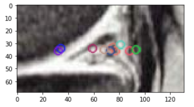 Keypoints extraits avec OpenCV sur une image de ménisque