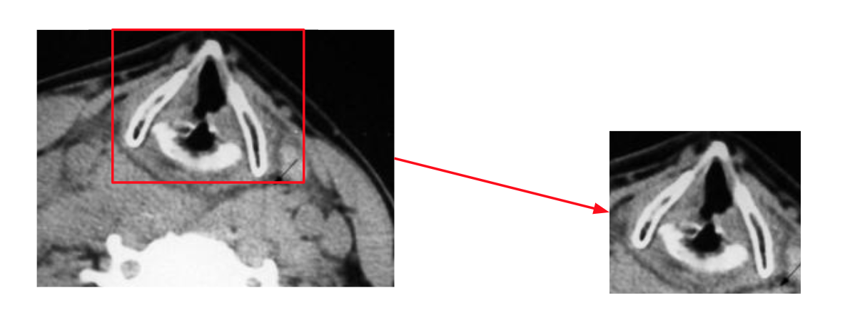 Illustration du recentrage sur le cartilage